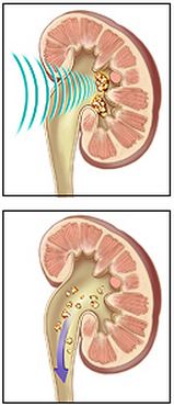 extracorporeal shock wave lithotripsy (ESWL)