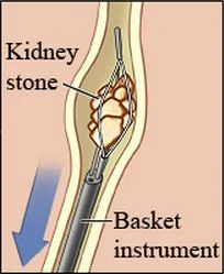 ureteroscopy