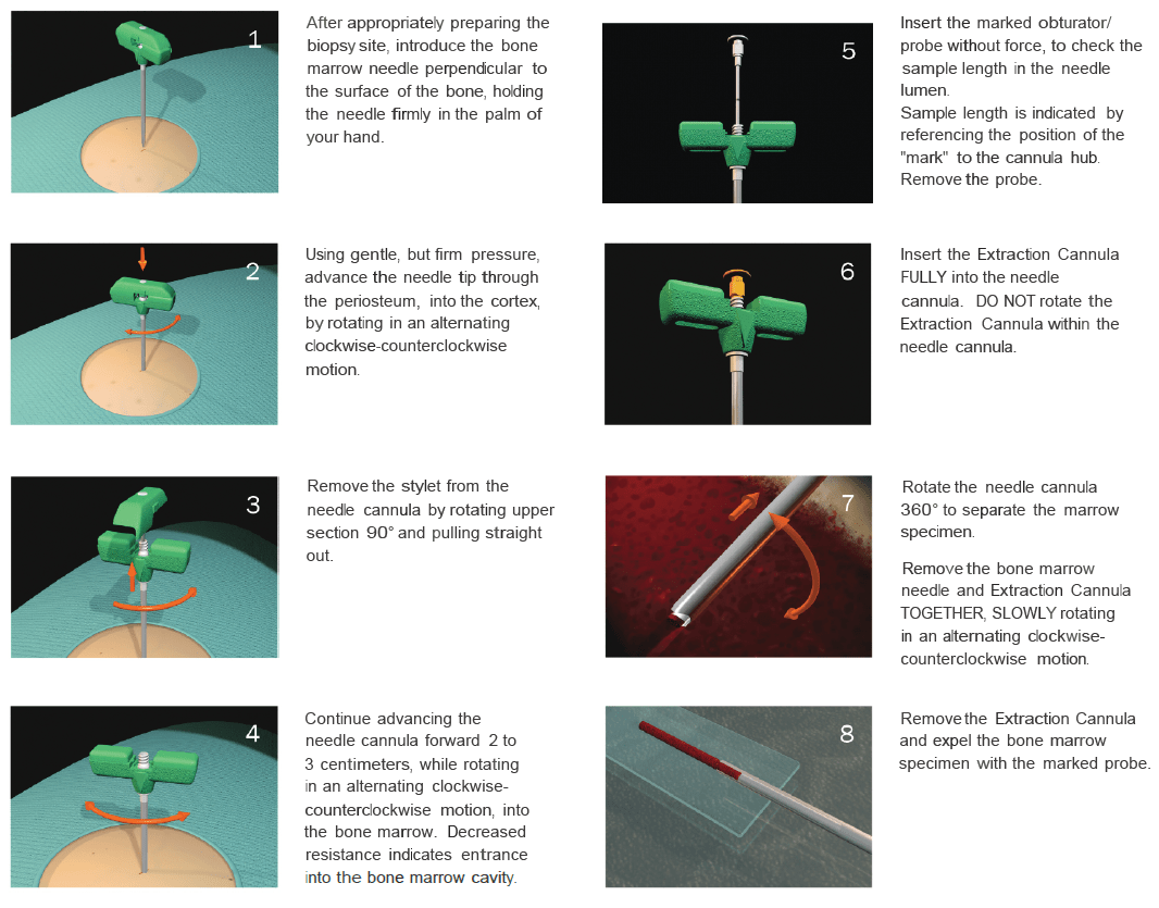 ifu bone marrow biopsy needle india