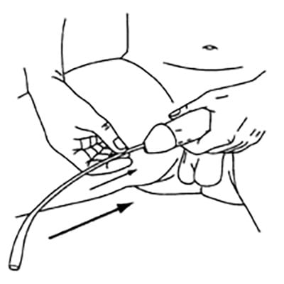 intermittent self catheterisation for males